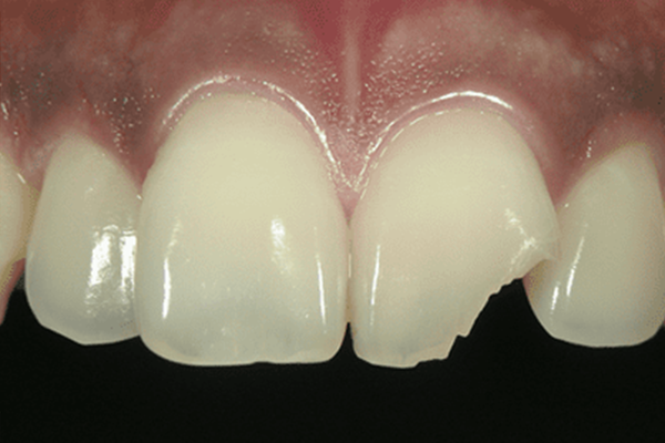 折れた前歯：削らずに理想的な歯の形に修正する場合1