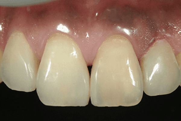 前歯の隙間：削らずに理想的な歯の形に修正する場合2