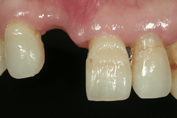 欠損した前歯：削らずに理想的な歯の形を構築する場合1